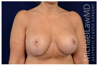Breast Implants after 1517004