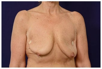 Breast Implants before 1517004