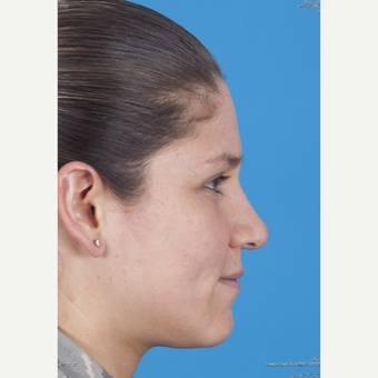 25-34 year old woman treated with Rhinoplasty before 3159504