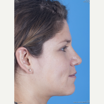 25-34 year old woman treated with Rhinoplasty after 3159504
