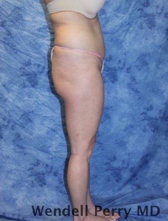 25-34 year old woman treated with Brazilian Butt Lift before 3360835
