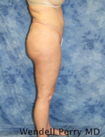 25-34 year old woman treated with Brazilian Butt Lift after 3360835