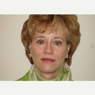 45-54 year old woman treated with Mini Lift and Upper Lid Blepharoplasty after 3264746