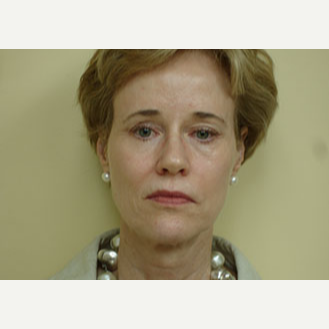 45-54 year old woman treated with Mini Lift and Upper Lid Blepharoplasty before 3264746