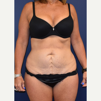 45-54 year old woman treated with Tummy Tuck before 3744544