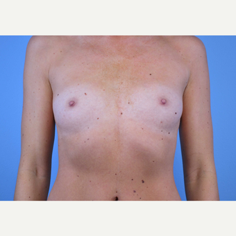 25-34 year old woman treated with Breast Implants before 3440030