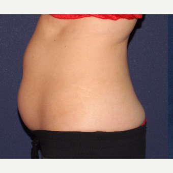 25-34 year old woman treated with CoolSculpting before 3138857