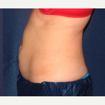 25-34 year old woman treated with CoolSculpting after 3138857