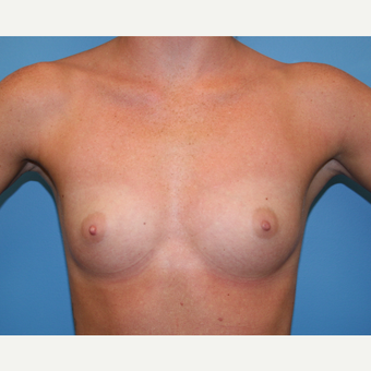 25 year old woman treated with Breast Augmentation before 3482856