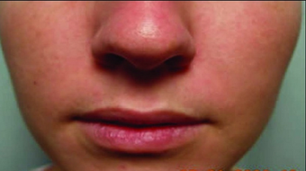 Restylane before 460608