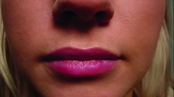 Restylane after 460608