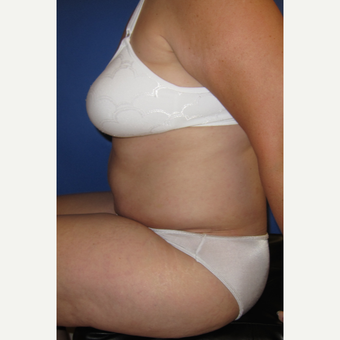 55-64 year old woman treated with Tummy Tuck after 3165572