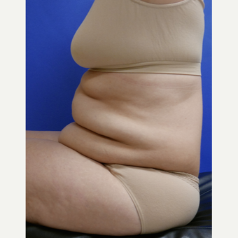 55-64 year old woman treated with Tummy Tuck before 3165572