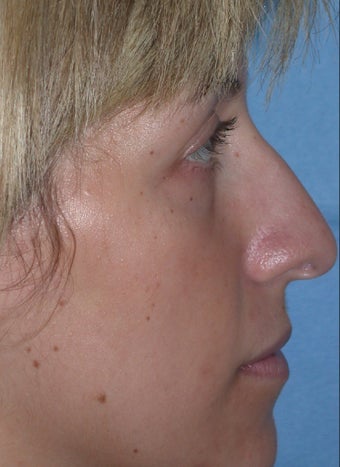 Rhinoplasty before 611289