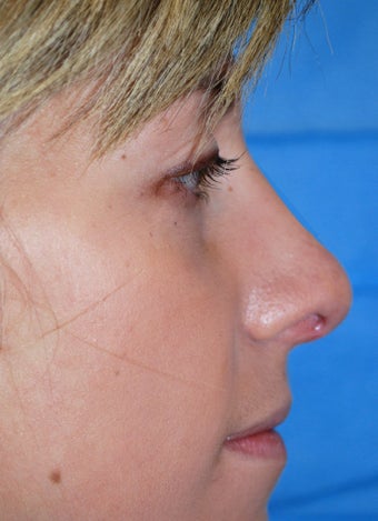 Rhinoplasty after 611289