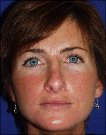 45 year old female with a nasal deformity after rhinoplasty with obstruction requesting revision surgery before 1017721