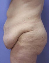 Extended abdominoplasty post gastric bypass 1091380