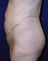 Extended abdominoplasty post gastric bypass 1091380