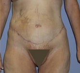 Extended abdominoplasty post gastric bypass after 1091380