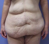 Extended abdominoplasty post gastric bypass before 1091380