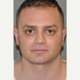 25-34 year old man treated with Rhinoplasty after 3566228