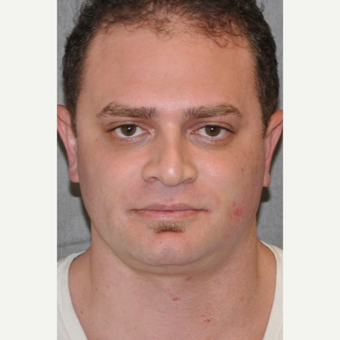 25-34 year old man treated with Rhinoplasty before 3566228