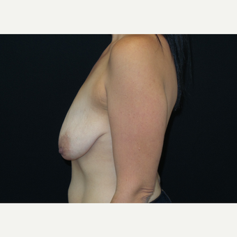25-34 year old woman treated with Breast Lift with Implants before 3305656