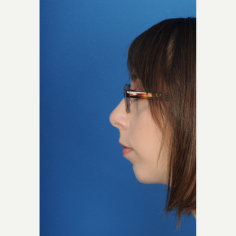 23 year old female with a small recessive chin underwent chin augmentation after 3839798