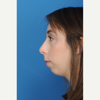 23 year old female with a small recessive chin underwent chin augmentation before 3839798