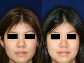 Rhinoplasty before 229772