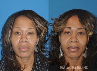 Lower Blepharoplasty before 1457386