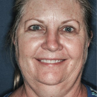 55-64 year old woman treated with Chin Liposuction before 2277503