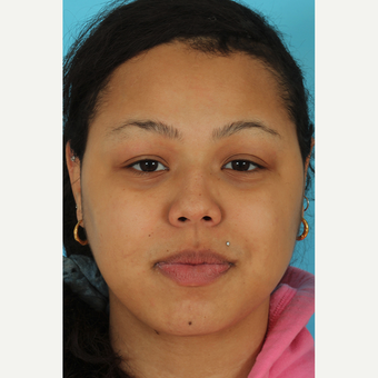 25-34 year old woman treated with Rhinoplasty before 3628907