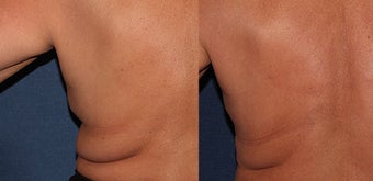CoolSculpting Before and After before 1251032