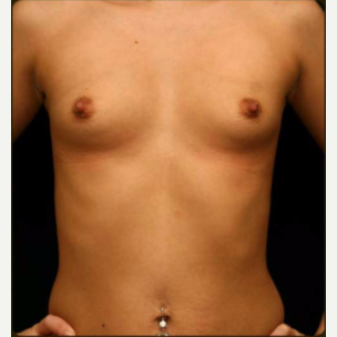 18-24 year old woman treated with Breast Augmentation before 3657805