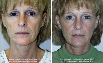 Dermabrasion before 1385311