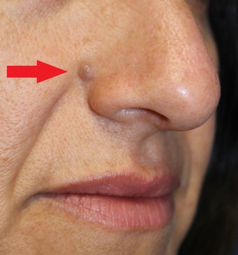 41 year old female for mole removal before 1254708