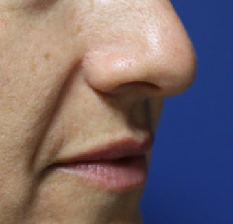 41 year old female for mole removal after 1254708