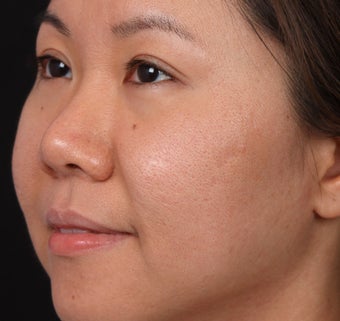 Acne Scar/Skin Texture Improvement for Asian skin after 1350493