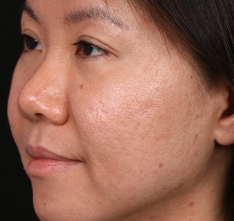 Acne Scar/Skin Texture Improvement for Asian skin before 1350493