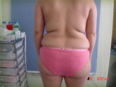 Brazilian Butt Lift female patient before 1057171