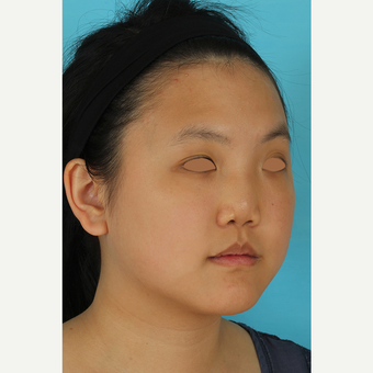 25-34 year old woman treated with Rhinoplasty before 3629047