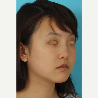 25-34 year old woman treated with Rhinoplasty after 3629047