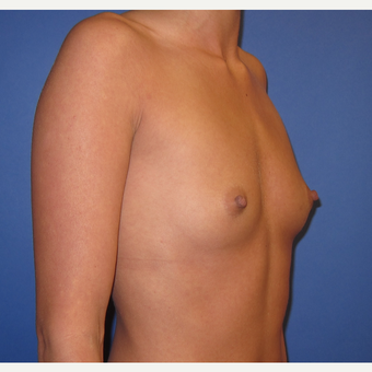 25-34 year old woman treated with Breast Augmentation (R. 295cc, L. 275cc) before 3544341