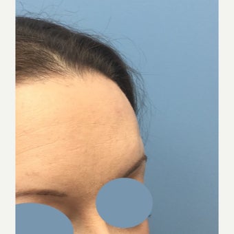 25-34 year old woman treated for Scar Removal after 2423723