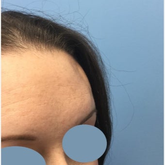 25-34 year old woman treated for Scar Removal before 2423723