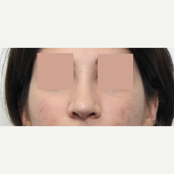 25-34 year old woman treated with Revision Rhinoplasty after 3777235