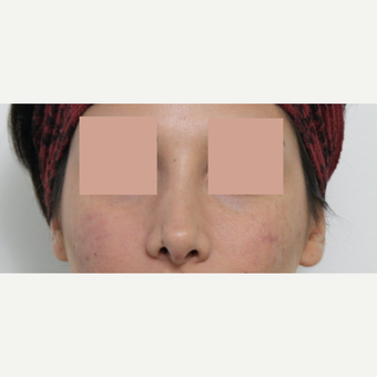 25-34 year old woman treated with Revision Rhinoplasty before 3777235
