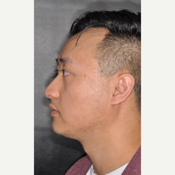 35-44 year old man treated with Nose Surgery 8 months post-op before 3500073