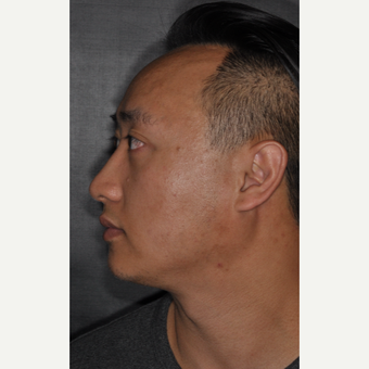 35-44 year old man treated with Nose Surgery 8 months post-op after 3500073